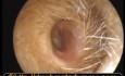 Perforacja tylno-boczna błony bębenkowej przez wyrastającego polipa z obecnością perlaka 