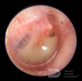 Ustępujące zapalenie ucha środkowego (poziom płynu)