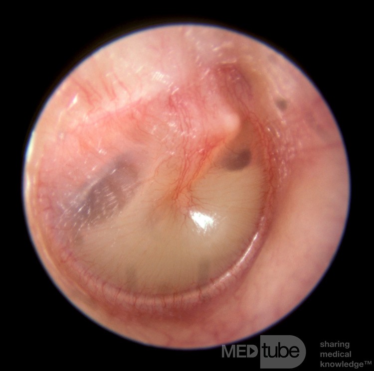 Ustępujące zapalenie ucha środkowego (poziom płynu)