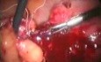 Leczenie laparoskopowe urazu jelita (powikłanie wkładki wewnątrzmacicznej)