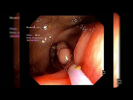 EMR (Mukozektomia endoskopowa) zmiany okołowyrostkowej po częściowym nacięciu obwodowym