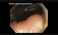 Zastawka krętniczo-kątnicza - polip dywanowy - endoskopowa mukozektomia