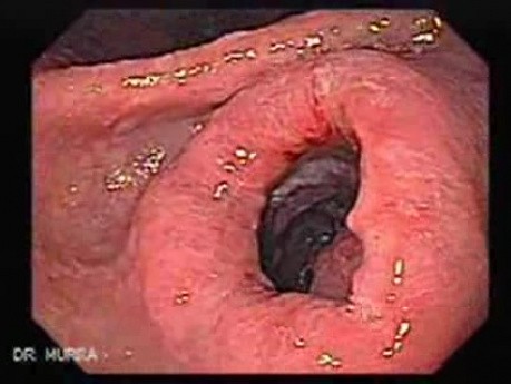 Rak żołądka - metaplazja jelitowa - endoskopia (4 z 7)