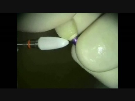 Szynowanie EverStick Perio przy ruchomości implantu