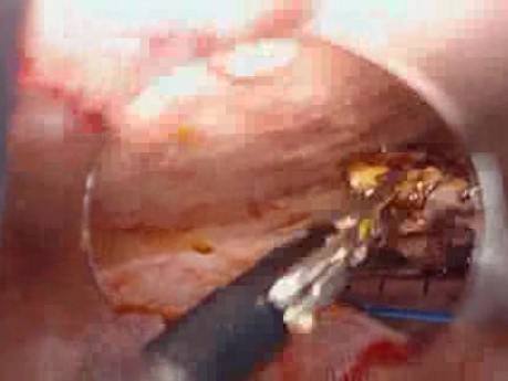 Perforacja okrężnicy z zapaleniem otrzewnej - laparoskopia (8 z 46)
