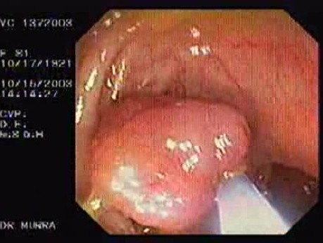 Gruczolak cewkowo - kosmkowy - endoskopia (6 z 28)