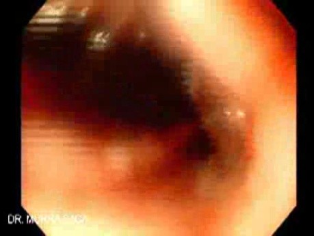 Krwawienie z górnej części przewodu pokarmowego z powodu żylaków przełyku - płukanie żołądka ujawnia miejsce krwawienia