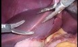 Abord Laparoscopique Biliaire chez un Donneur Vivant présentant deux Veines Portes et Deux Canaux Biliaires dans le Lobe Droit du Greffon