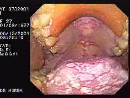 Leukoplakia na śluzówce policzków - kandydoza jamy ustnej, gardła i przełyku - 2/5