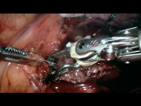 Resekcja guza okolicy okienka aortalno-płucnego z użyciem robota