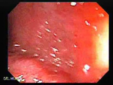 Zapalenie jelita grubego w przebiegu choroby Leśniowskiego-Crohna (2 z 3)