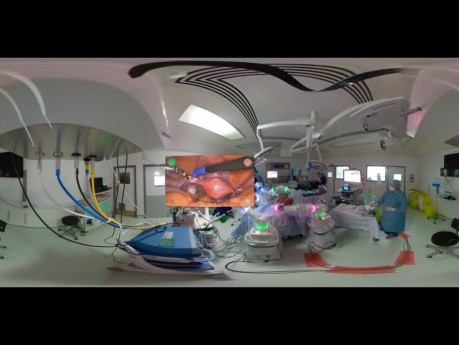 Histerektomia przy użyciu systemu Versius w widoku 360° w Milton Keynes University Hospital