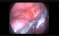 Laparoskopia z powodu krwi w jamie otrzewnej z torbieli krwotocznej jajnika