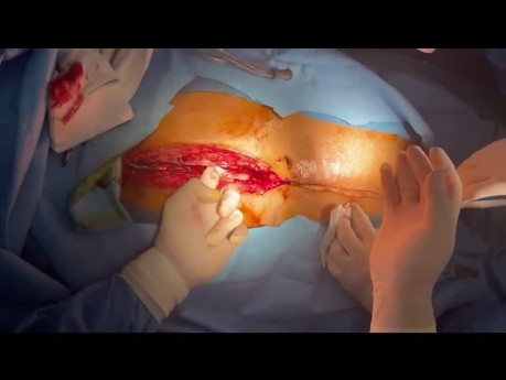 Dawstwo narządów po pomostowaniu tętnic wieńcowych