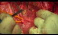Chirurgia cytoredukcyjna raka jajnika. Zmodyfikowane tylne wytrzewienie miednicy.