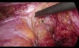 Nawrót raka odbytnicy - reoperacja laparoskopowa z użyciem techniki TME