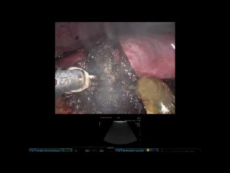 Resekcja za pomocą robota raka wątrobowokomórkowego segmentu VI w marskości wątroby z manewrem Pringle'a 