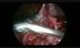 Laparoskopowa operacja olbrzymiego potworniaka jajnika u pacjentki w ciąży