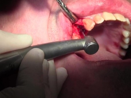 Ekstrakcja zęba 1-5 z jednoczesnym przeszczepem kostnym - d-PTFE - ekstrakcja, plastyka podniebienia i chirurgiczne oczyszczanie rany (debridement)