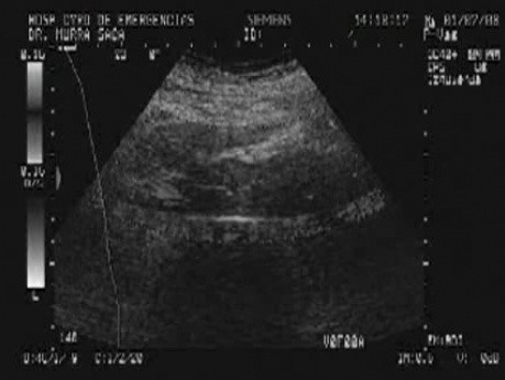 Rak jajnika z przerzutami do żołądka i dwunastnicy - USG jamy brzusznej, część 2