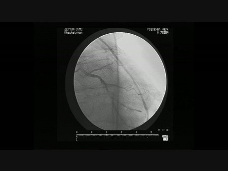 Koronarografia 5 lat po pomostowaniu aortalno-wieńcowym z użyciem obu tętnic piersiowych wewnętrznych