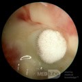 Mieszane grzybicze i bakteryjne zapalenie ucha zewnętrznego