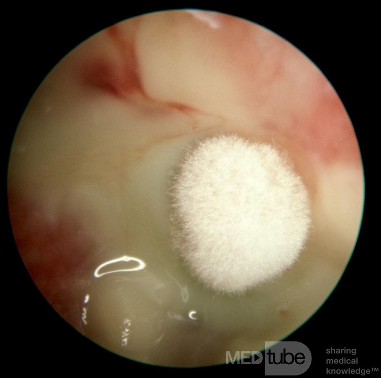 Mieszane grzybicze i bakteryjne zapalenie ucha zewnętrznego
