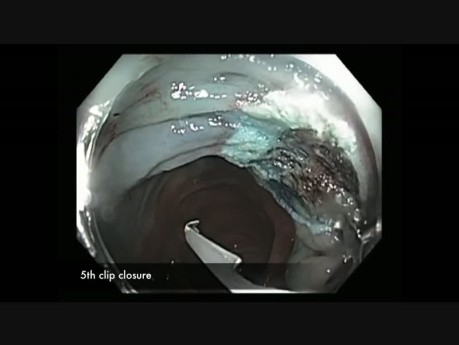 Kolonoskopia: zamykanie ubytków po endoskopowej resekcji śluzówkowej 1