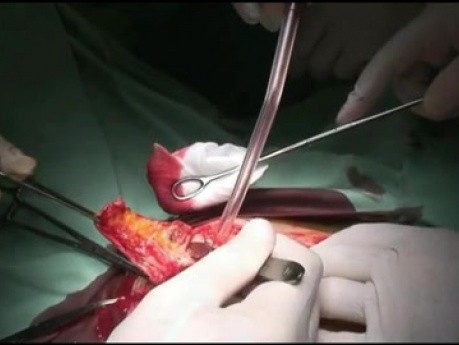 Zastosowanie noża plazmowego w operacyjnym leczeniu endometriozy