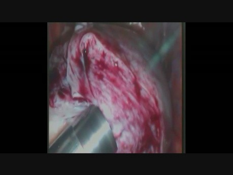 Całkowita laparoskopowa histerektomia włókniaka z morcelacją