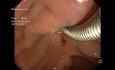Ampullectomie - Partie V