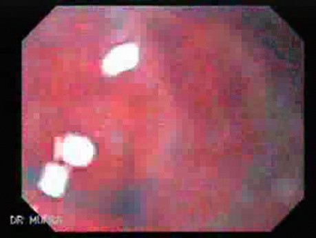 Rak włóknisty żołądka - endoskopia w dużym powiększeniu (5 z 15)
