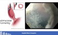 Myotomie endoscopique perorale (POEM) pour le traitement des troubles hypercontractiles de l'œsophage