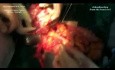 Operacja chirurgiczna wieloogniskowego mięsaka jamy brzusznej