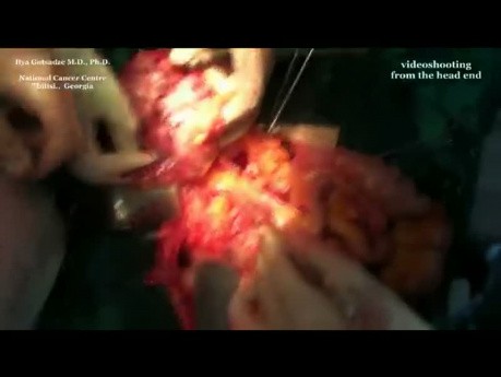 Operacja chirurgiczna wieloogniskowego mięsaka jamy brzusznej