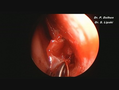 Septoplastyka i konchoplastyka endoskopowa
