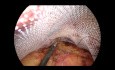 Technika szycia laparoskopowego w TAPP w operacjach przepuklin pachwinowych