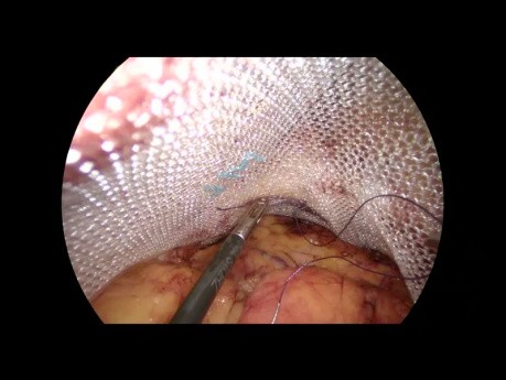 Technika szycia laparoskopowego w TAPP w operacjach przepuklin pachwinowych