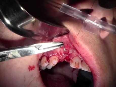 Ektrakcja zęba 1-7 z przeszczepem kostnym kieszeni