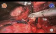 Lobektomia dolnej części prawego płuca przy wykorzystaniu robota Versius - L Rosso