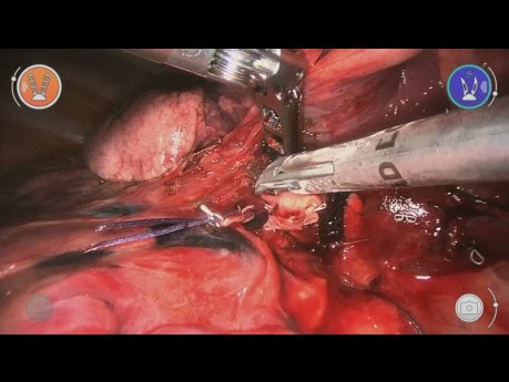 Lobektomia dolnej części prawego płuca przy wykorzystaniu robota Versius - L Rosso