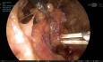 Axilloscopic Lymph Node Dissection : A Technical Guide Navigating the Complex Neurovascular Anatomy of the Axilla