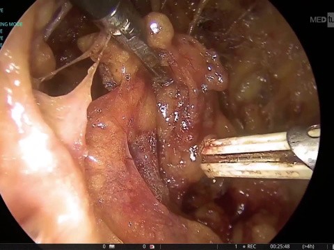 Axilloscopic lymph node dissection 