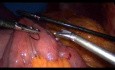 Operacja żołądka metodą Gastric bypass - część 3