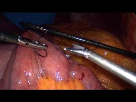 Operacja żołądka metodą Gastric bypass - część 3