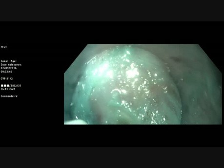 Endoskopowa podśluzówkowa resekcja zmiany w przełyku