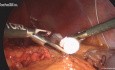 Hemostaza i uszczelnienie tkanek w chirurgii przewodu pokarmowego