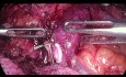 Laparoskopowa całkowita resekcja trzustki z powodu guza głowy trzustki