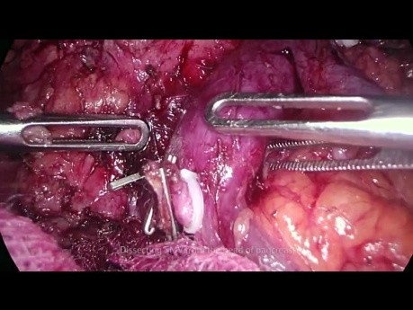 Laparoskopowa całkowita resekcja trzustki z powodu guza głowy trzustki
