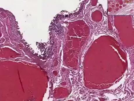 Choroba hemoroidalna